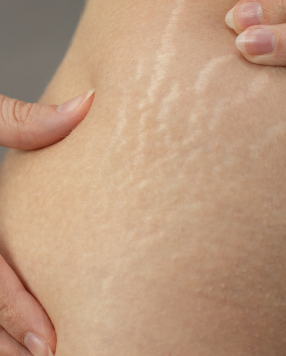 Closeup on a woman's stretchmarks