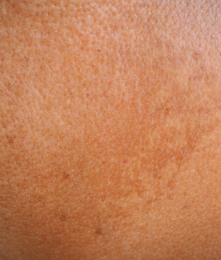 Closeup of sun-damaged skin